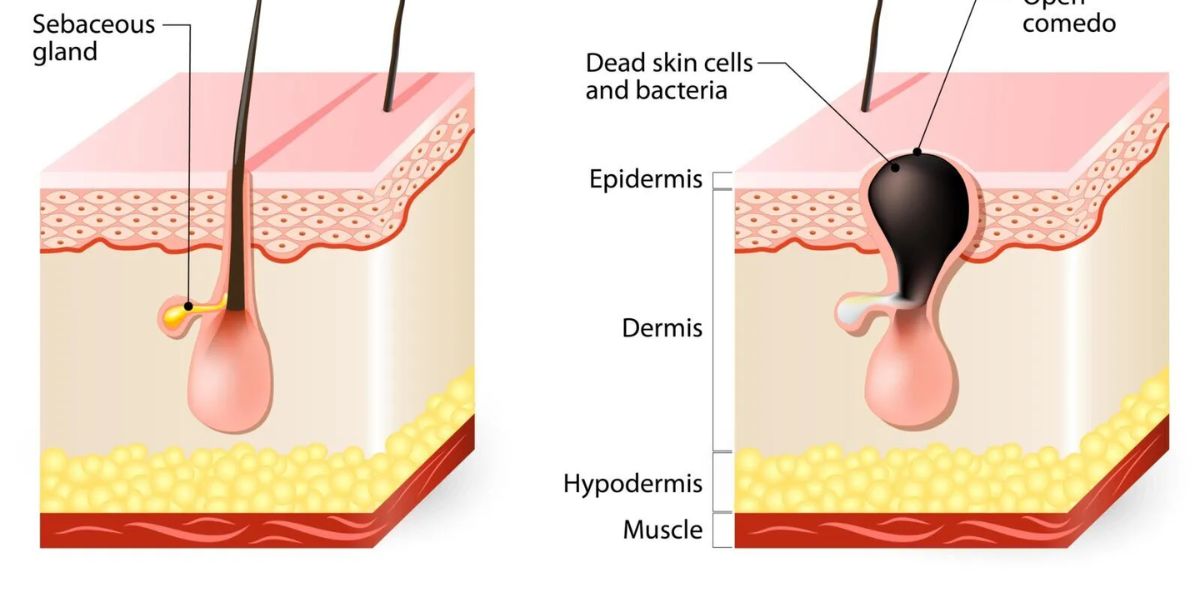 How to Remove Blackheads?